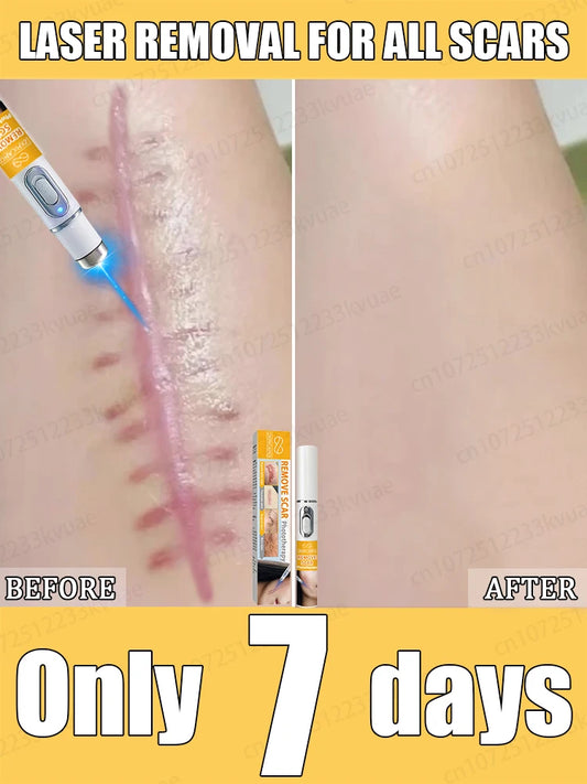 Appareil à Laser Manuel Anti-Cicatrices – Soin Ciblé pour une Peau Plus Lisse